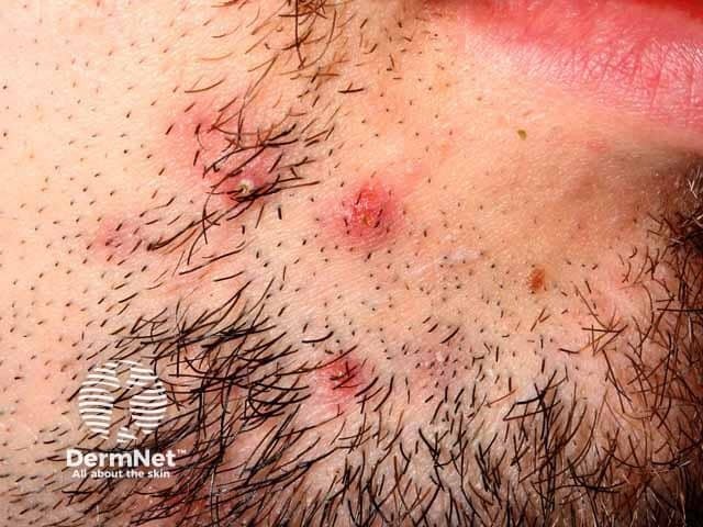 آفات أعمق ومؤلمة في حالة "سيكوزيس باربي" (التهاب جريبات اللحية العميق)