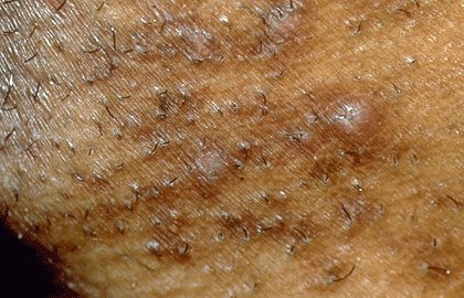 التهاب الجريبات الكاذب (أو نتوءات الحلاقة) في منطقة اللحية