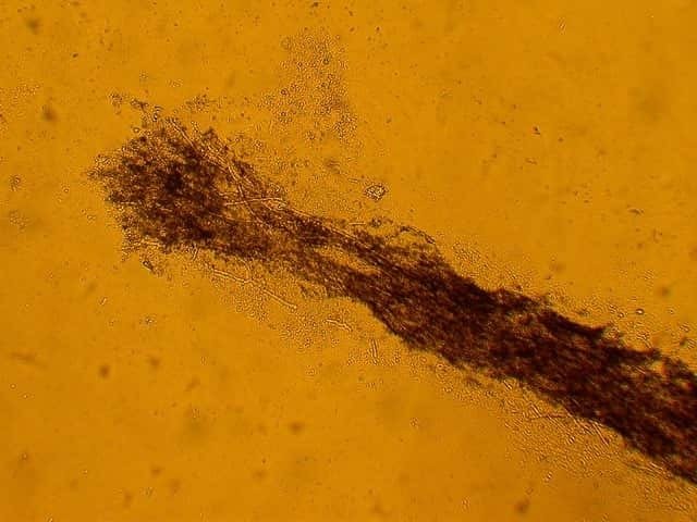 غزو خارجي (Ectothrix) لساق الشعرة بواسطة الخيوط الفطرية